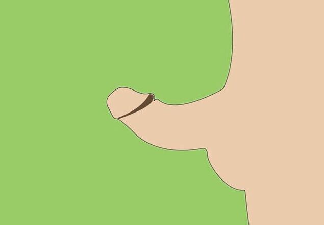 zakrivenie penisu ako indikácia na chirurgické zväčšenie